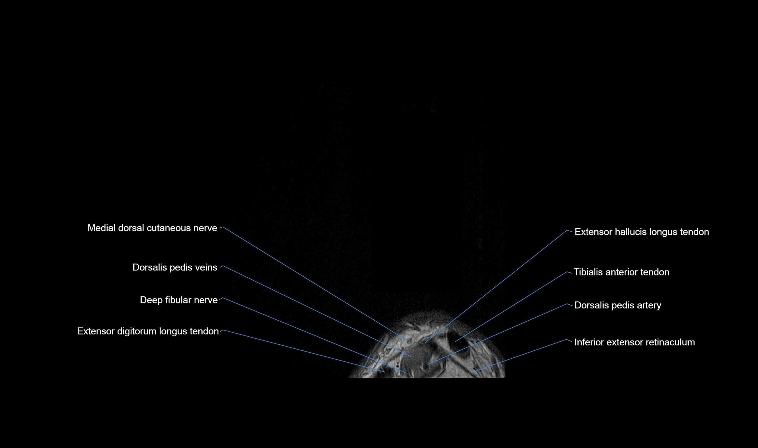 MRI mid foot coronal ligaments cross sectional anatomy 3T  radiology  image-img-00001-00001.webp